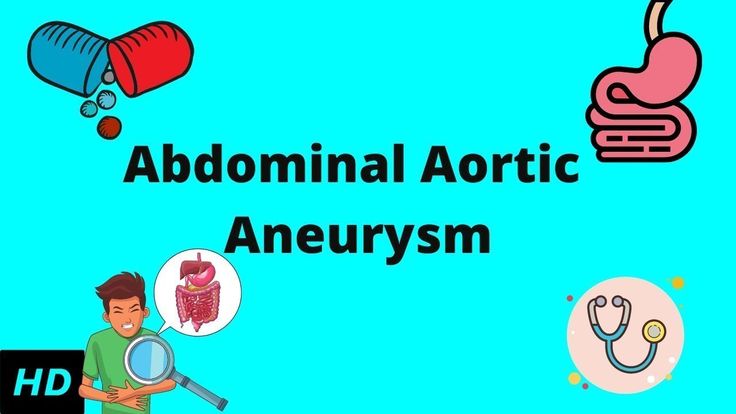 Abdominal Aortic Aneurysm