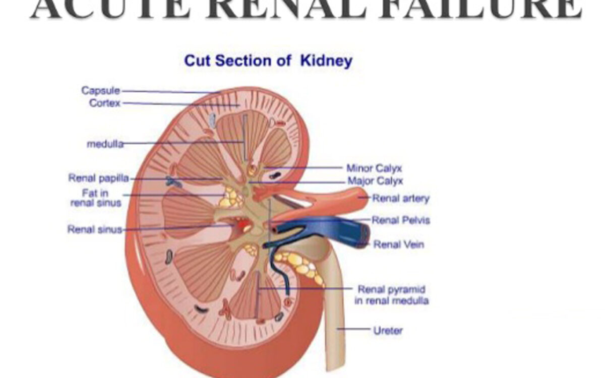 Acute kidney failure Acute kidney failure